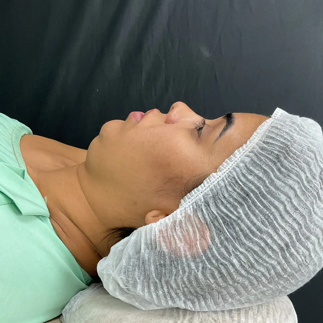 Cervicoplastia antes