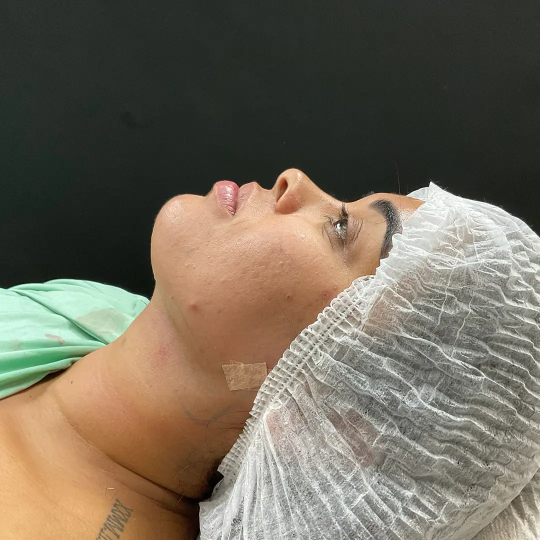 Cervicoplastia depois