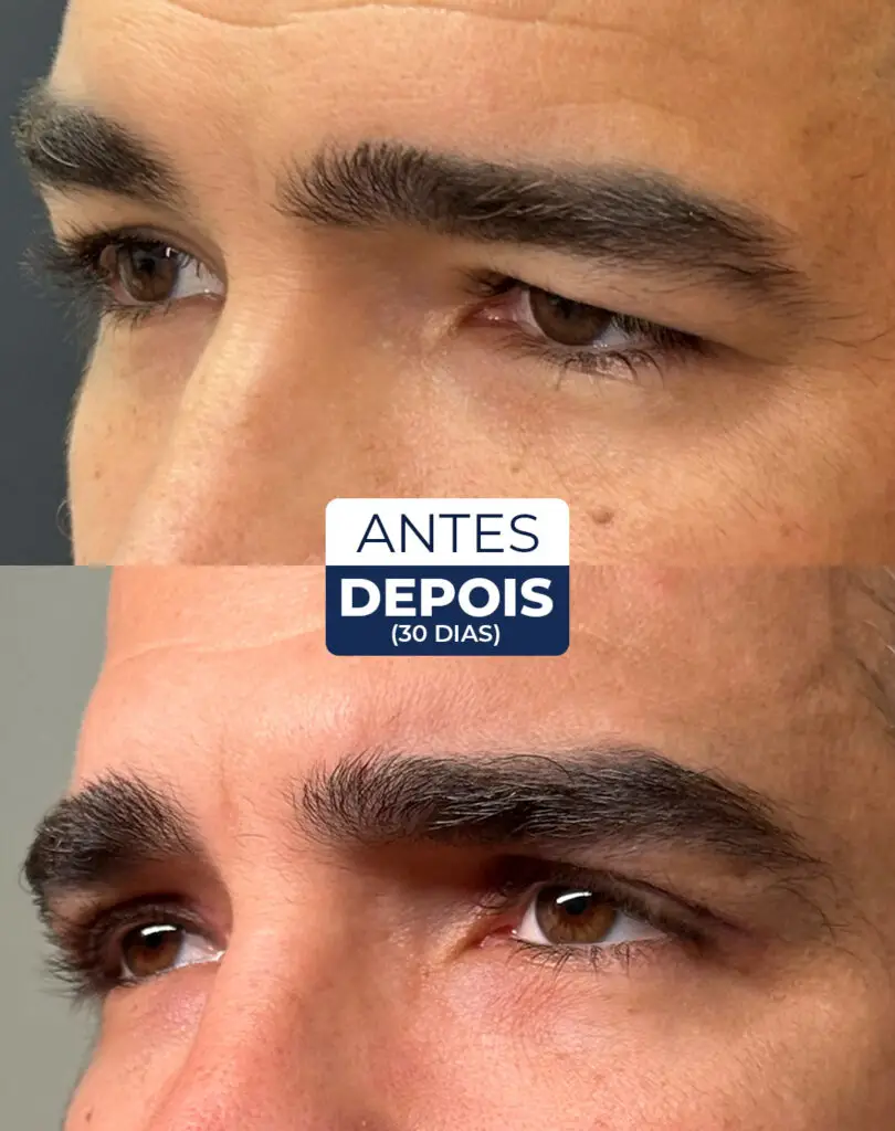 antes e depois blefaro 01