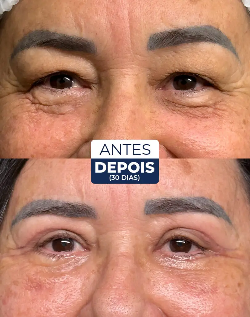 antes e depois blefaro 02