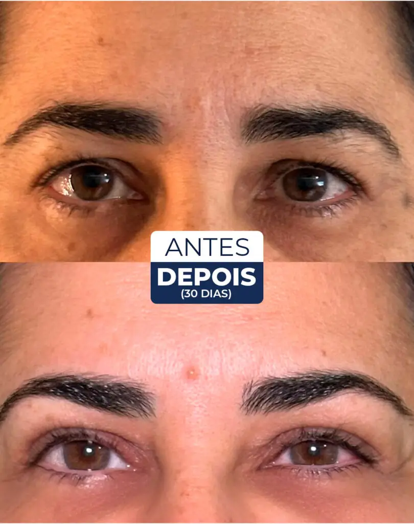antes e depois blefaro 03