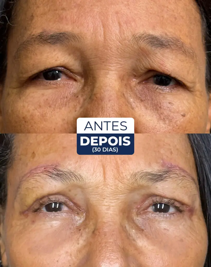 antes e depois blefaro 04